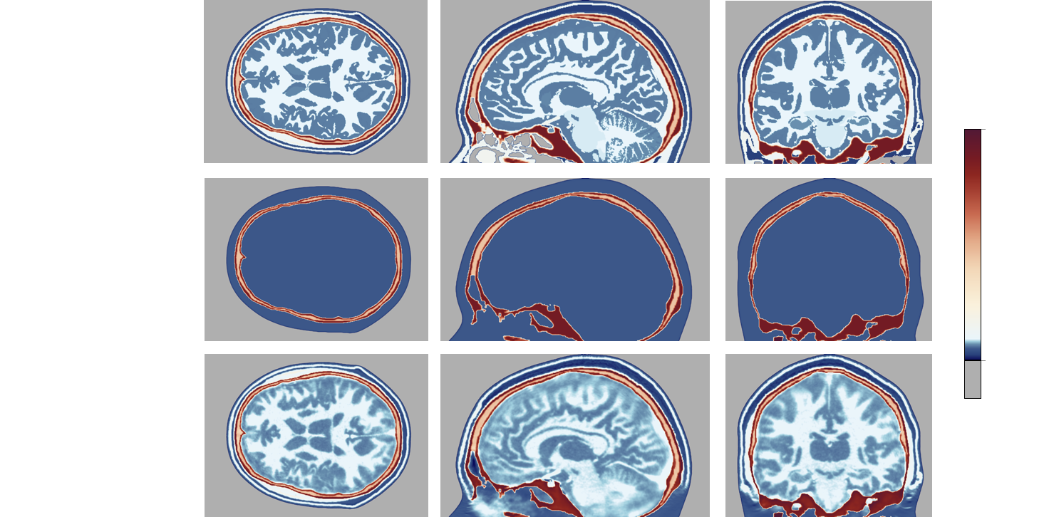 FWI applied to brain imaging